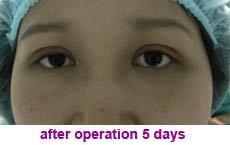 plastic-surgery-blepharoplasty